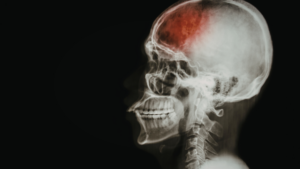 Serious Injuries Commonly Associated With a Gwinnett County Car Crash